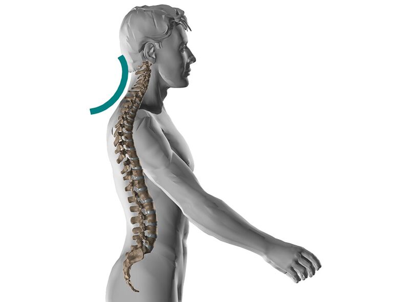 Ostéochondrose cervicale de la colonne vertébrale, provoquant de nombreux symptômes désagréables