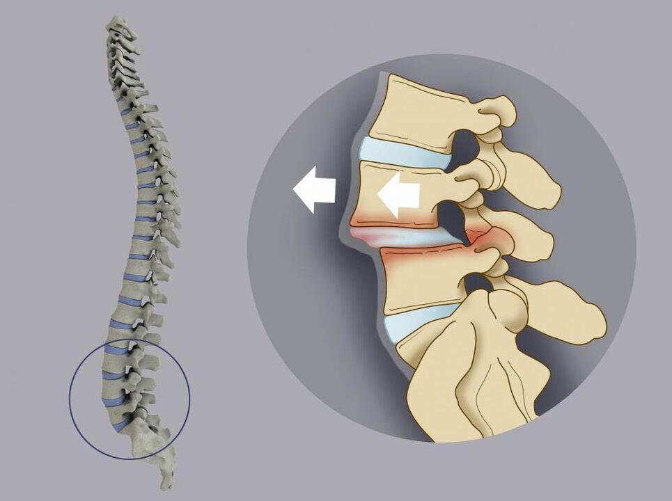 le mauvais alignement vertébral comme cause de lombalgie