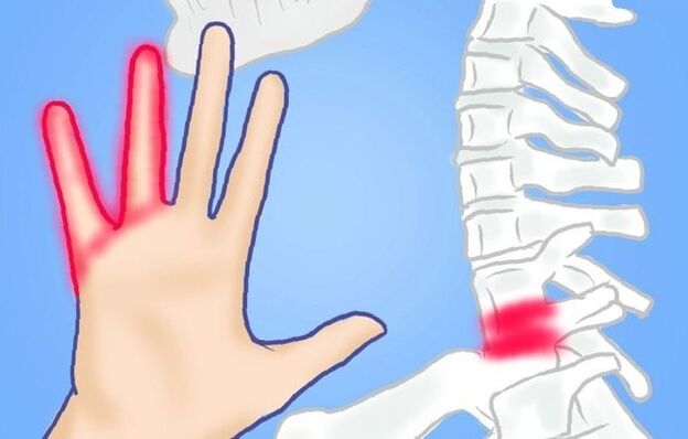 nerfs pincés comme cause de douleurs lombaires